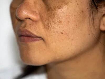 sculptra kaufen – MorySkin bietet zertifizierte Produkte
