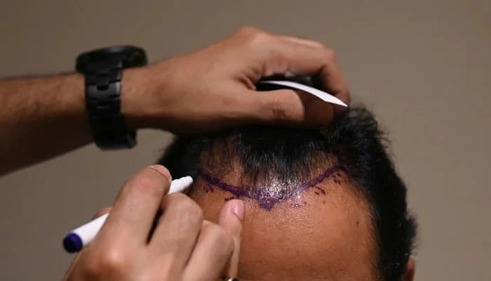 Haarausfall Nürnberg: Faltenbehandlung, Hautstraffung und Lippenunterspritzung für Ihre Schönheit