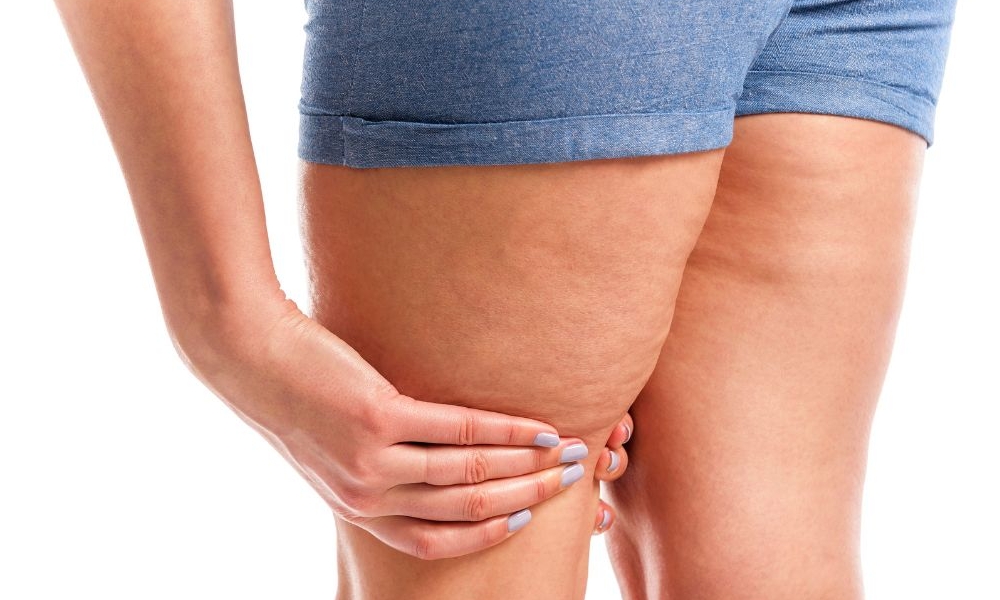 Anzeichen Lipödem erkennen – Selbsttest: Habe ich ein Lipödem?