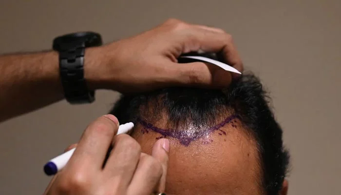 Haarausfall Nürnberg: Faltenbehandlung, Hautstraffung und Lippenunterspritzung für Ihre Schönheit