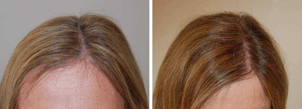 Haartransplantation 101: Den Prozess und die Vorteile verstehen