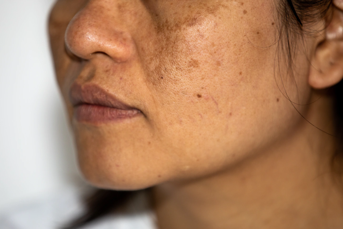 sculptra kaufen – MorySkin bietet zertifizierte Produkte