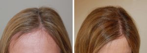 female-patient-before-and-after-500-grafts-transplantation