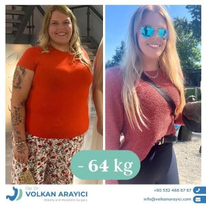 magenverkleinerung-tuerkei-kosten.